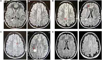 Should we treat pediatric radiologically isolated syndrome? An 18-year follow-up case report